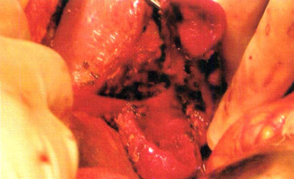 慢性膽囊炎(病例2)